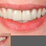 протезирование зубов в беларуси